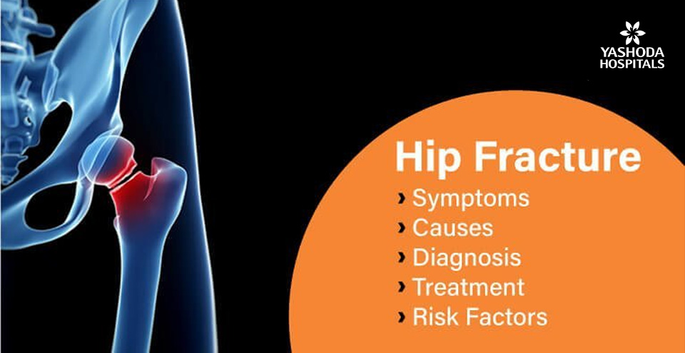 How to treat hip fractures?