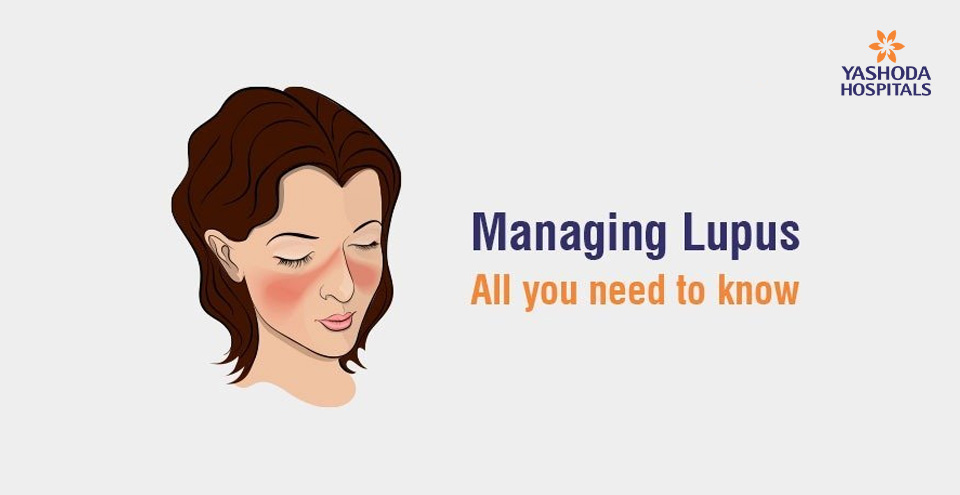 Managing Lupus:All you need to know