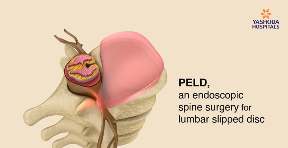 Herniated disc, its causes, symptoms and treatment – PELD