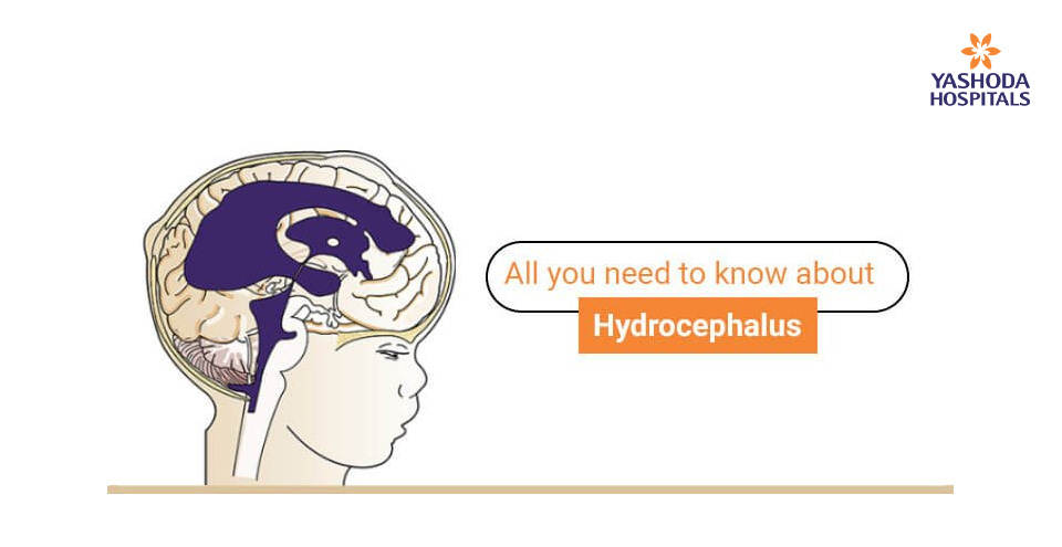 Hydrocephalus, a most common reason for brain surgery in kids