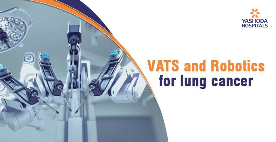 VATS and robotic surgery for lung cancer – Frequently asked questions