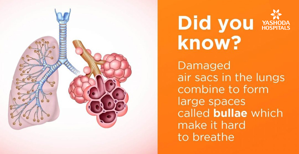 Can Air In Your Lungs Be Bad News?