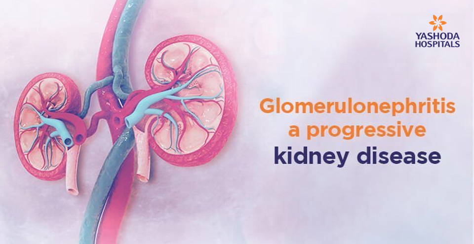 Glomerulonephritis – a kidney disease