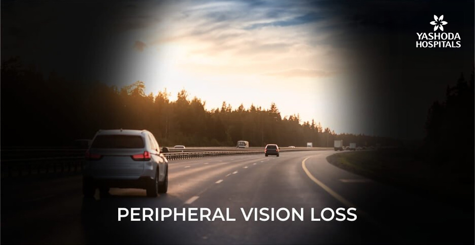 How does peripheral vision loss affect daily life?