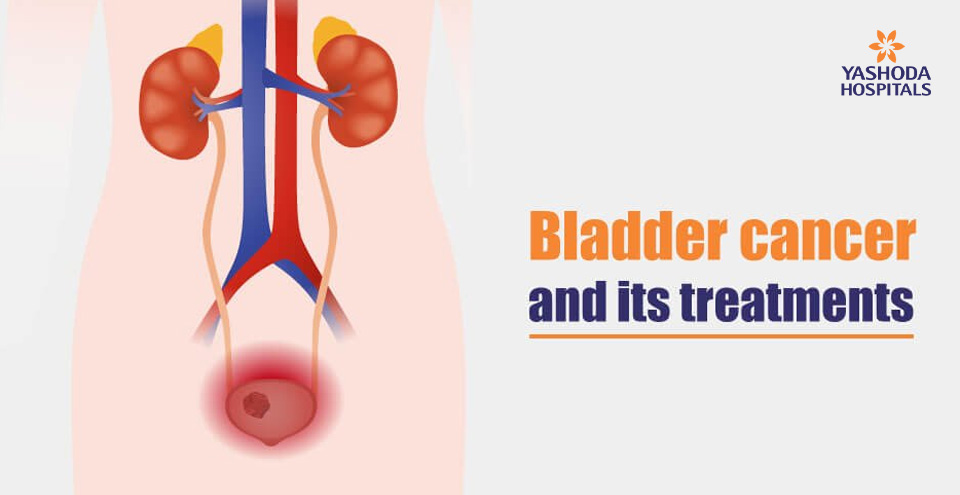 Bladder cancer and its treatments