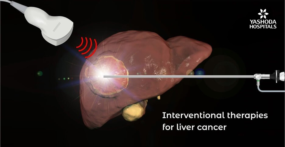 Minimally invasive interventional radiology therapies for liver cancer