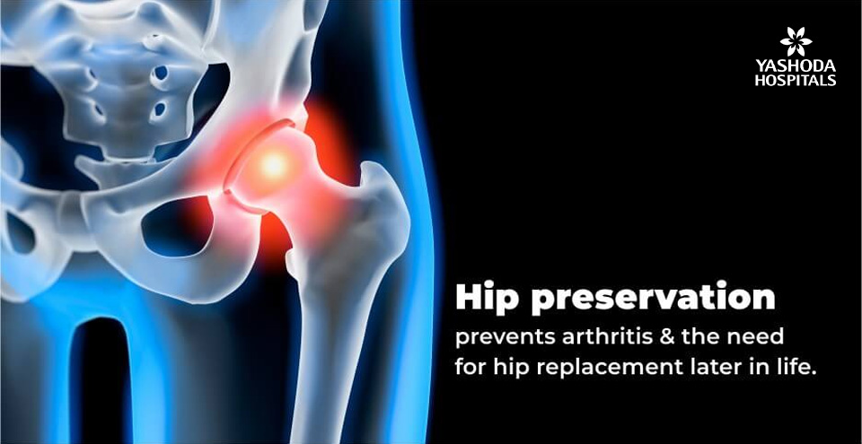 Hip joint preservation – What is it and why?