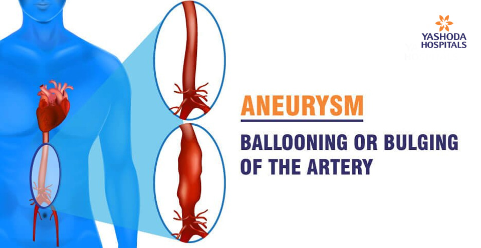 Aneurysms – its causes, symptoms, diagnosis and treatment