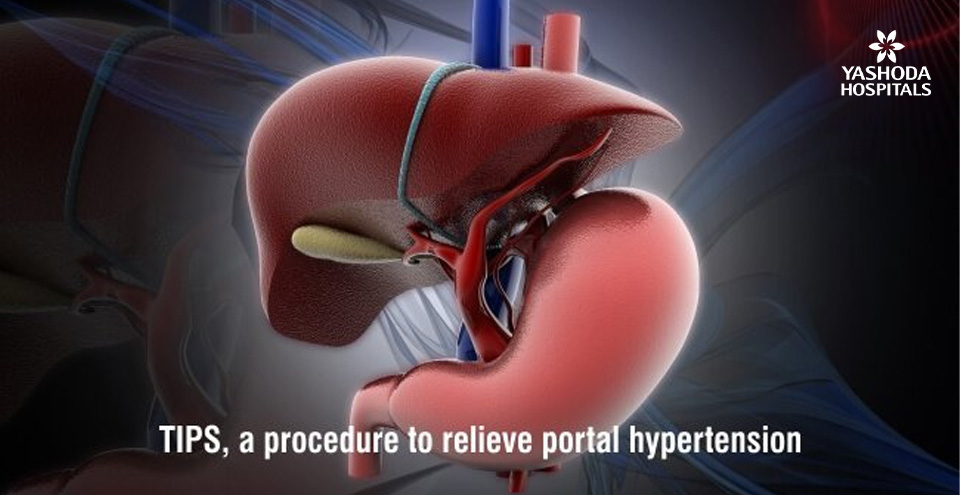 Portal hypertension and TIPS (Transjugular Intrahepatic Portosystemic Shunt)