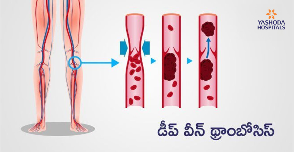 డీప్‌ వీన్‌ థ్రాంబోసిస్‌(Deep Vein Thrombosis)