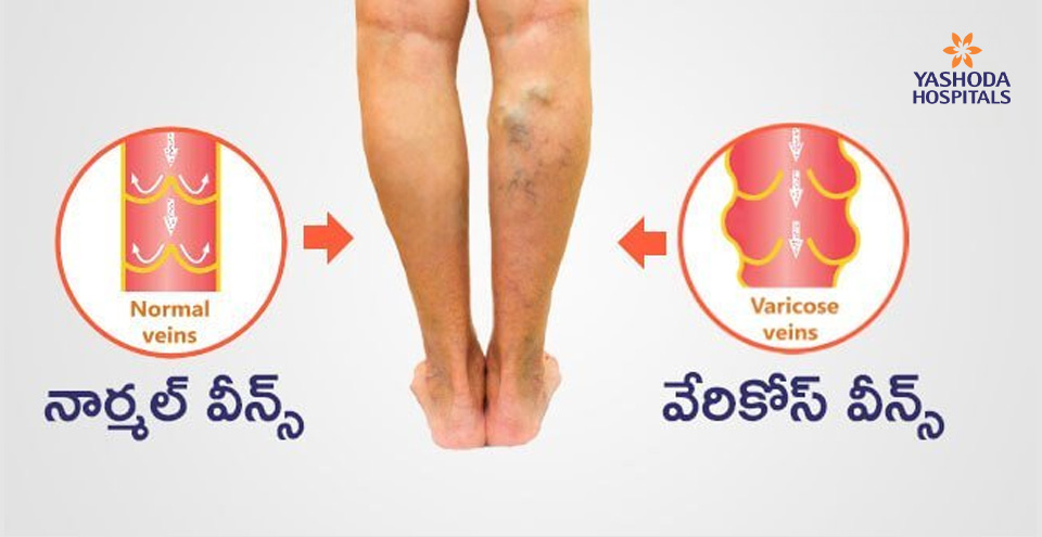 వేరికోస్‌ వీన్స్‌(Varicose Veins)