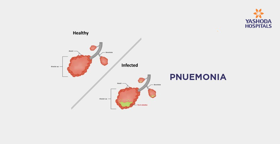 Pneumonia: Types, Causes, Symptoms, Diagnosis and Treatment