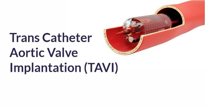 Trans Catheter Aortic Valve Implantation (TAVI)