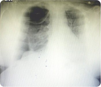 Bullous Lung Disease with Spontaneous Right Sided Pneumothorax