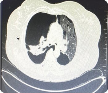 Bullous Lung Disease with Spontaneous Right Sided Pneumothorax