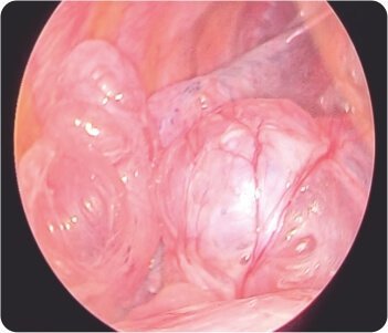 Bullous Lung Disease with Spontaneous Right Sided Pneumothorax