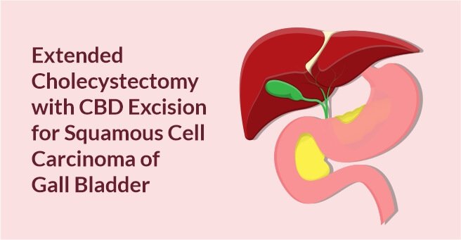 Extended Cholecystectomy with CBD Excision for Squamous Cell Carcinoma of Gall Bladder