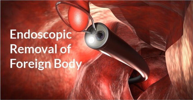 Endoscopic Removal of Foreign Body Case-1