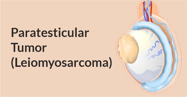 Paratesticular Tumor Leiomyosarcoma