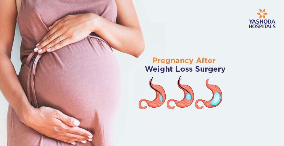 Pregnancy After Weight Loss Surgery