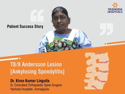 Ankylosing Spondylitis