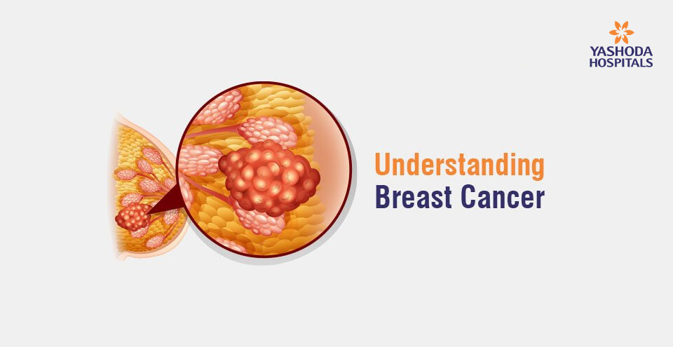 Understanding Breast Cancer