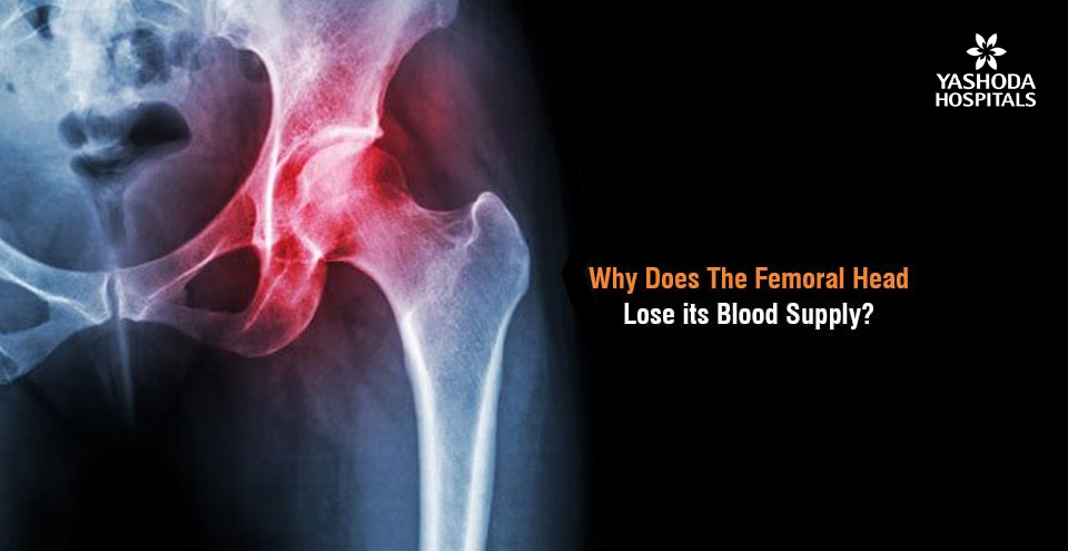 Why does the femoral head loose its blood supply?