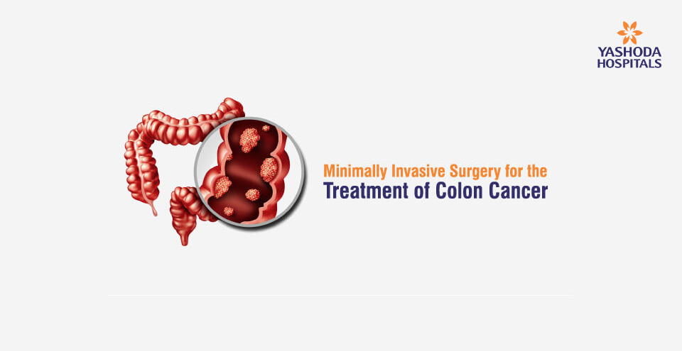 Minimally Invasive Surgery for the Treatment of Colon Cancer