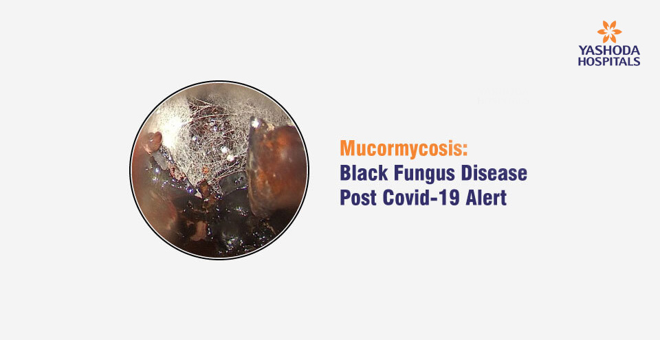 Mucormycosis:  Black Fungus Disease Post Covid-19 Alert