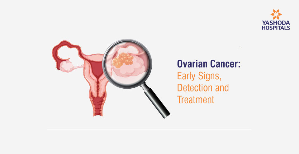 Ovarian Cancer : Early Signs, Detection and Treatment