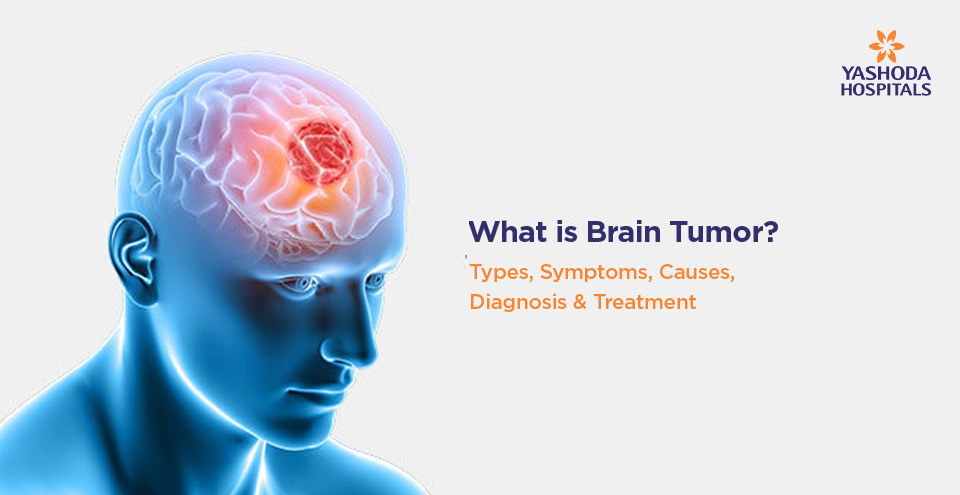 What is Brain Tumor? Types, Symptoms, Causes, Diagnosis & Treatment