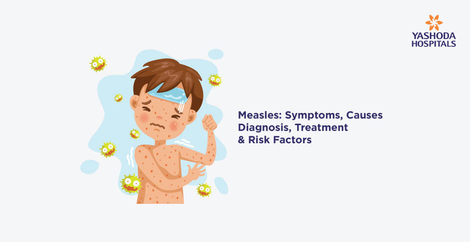 Measles: Symptoms, Causes, Diagnosis, Treatment & Risk Factors