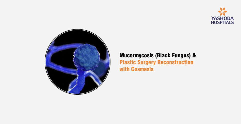 Mucormycosis (Black Fungus) and Plastic Surgery Reconstruction with Cosmesis