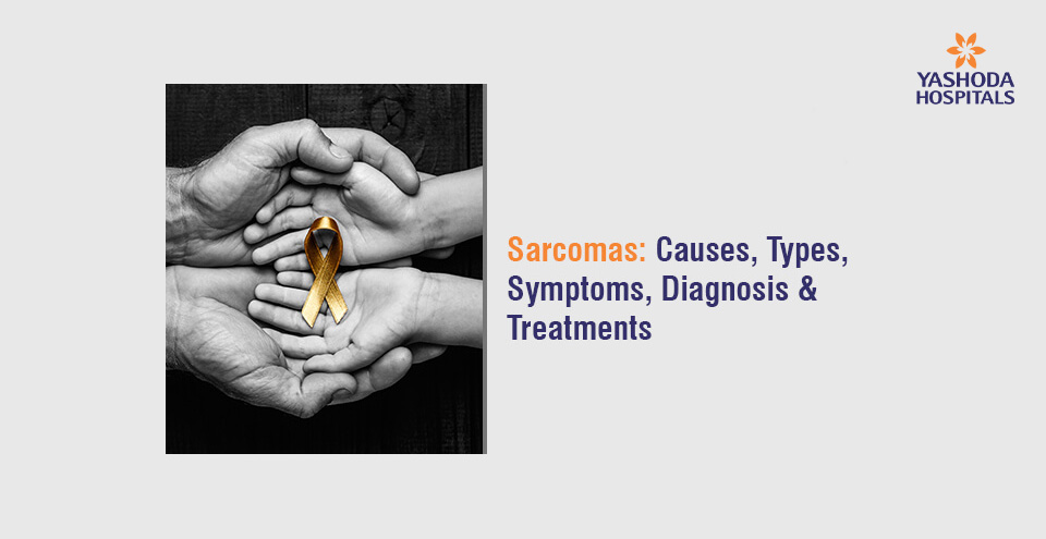 Sarcomas: Causes, Types, Symptoms, Diagnosis & Treatment