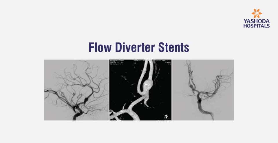 Flow Diverter Stents