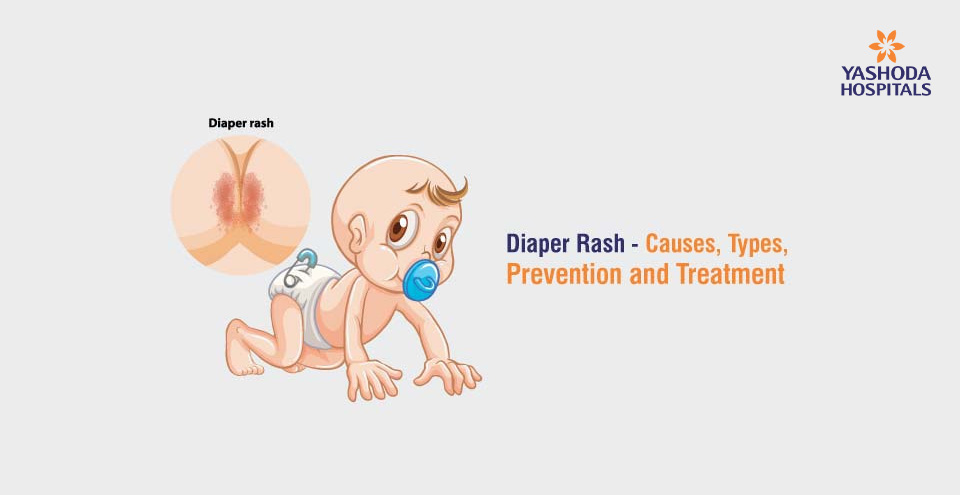 Diaper Rash – Causes, Types, Prevention and Treatment