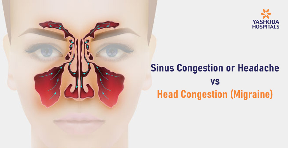 Sinus Congestion or Headache vs Head Congestion (Migraine)