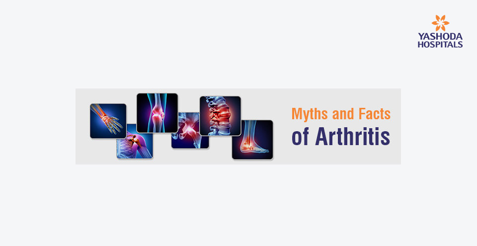 Myths and Facts of Arthritis