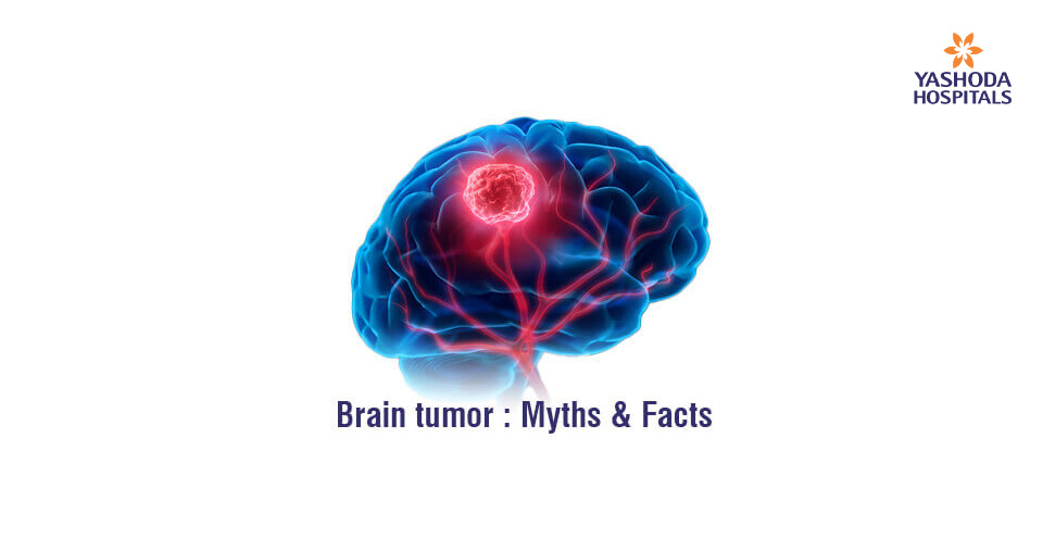 Brain tumor : Myths & Facts