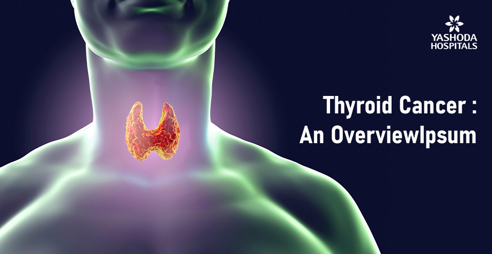 Thyroid Cancer: An Overview