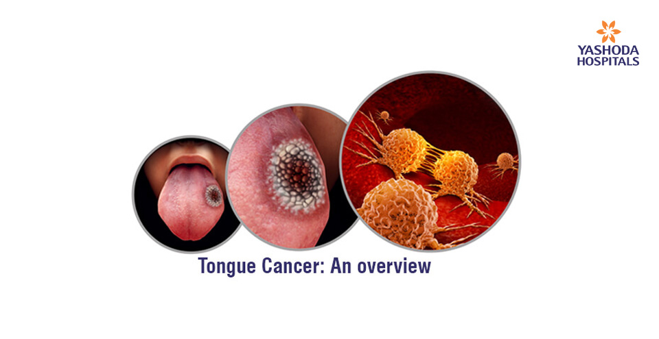 Tongue Cancer: An overview