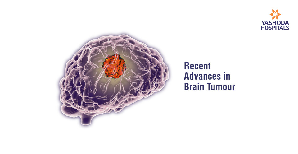 Recent Advances in Brain Tumour