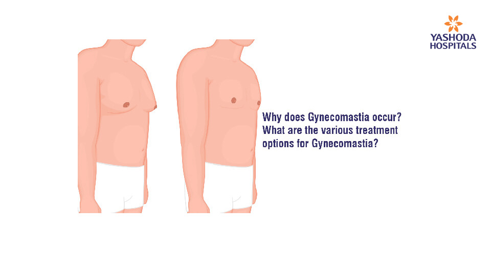 Why does Gynecomastia occur? What are the various treatment options for Gynecomastia?