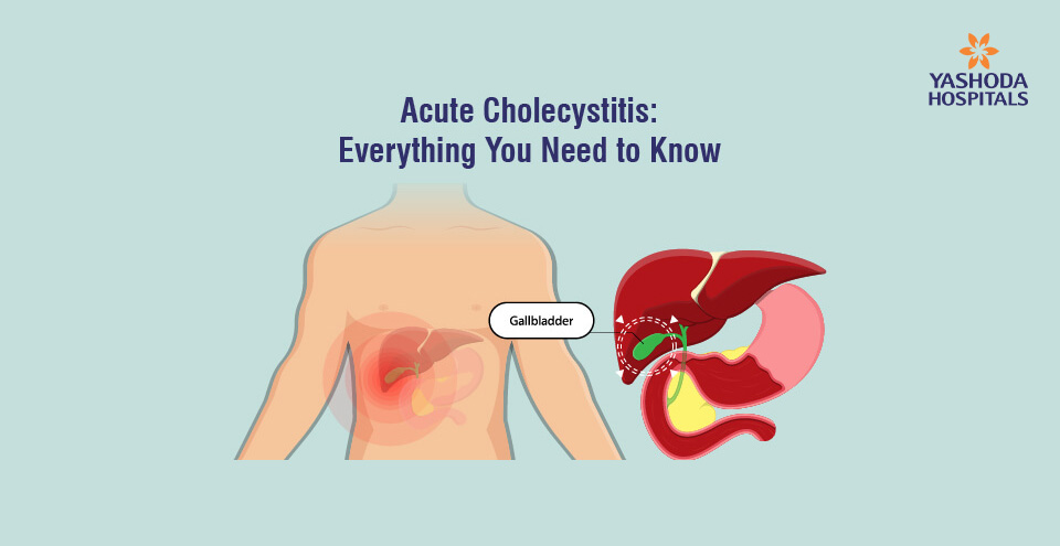 Acute Cholecystitis: Everything You Need to Know