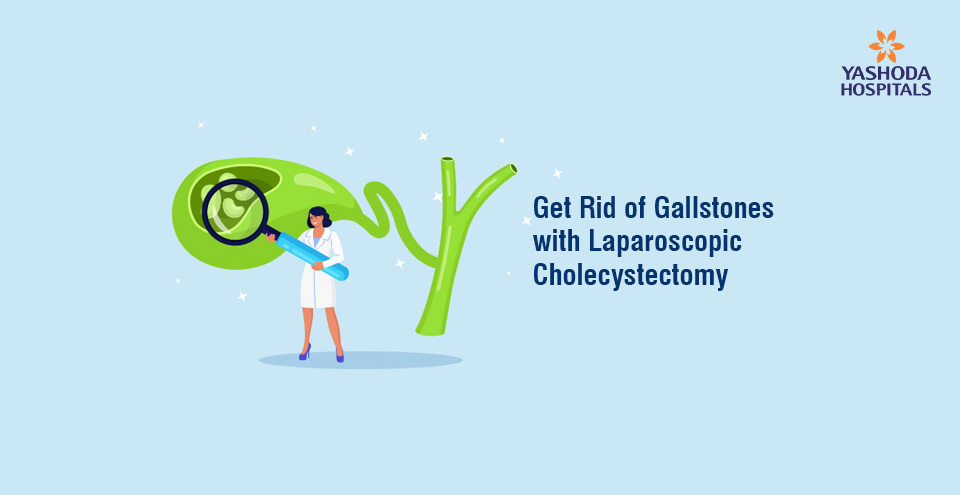 Get Rid of Gallstones with Laparoscopic Cholecystectomy