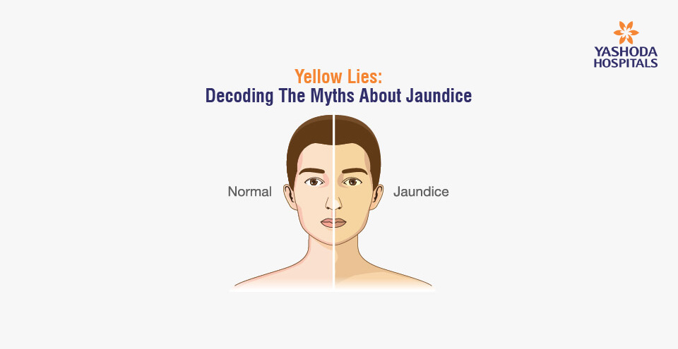 Yellow Lies: Decoding The Myths About Jaundice