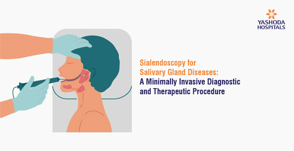 Sialendoscopy for Salivary Gland Diseases: A Minimally Invasive Diagnostic and Therapeutic Procedure