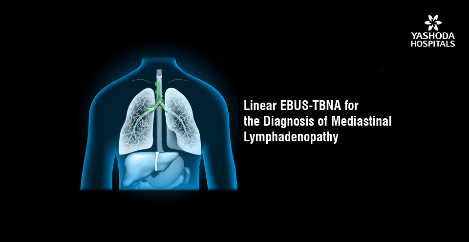 Mediastinal Lymphadenopathy