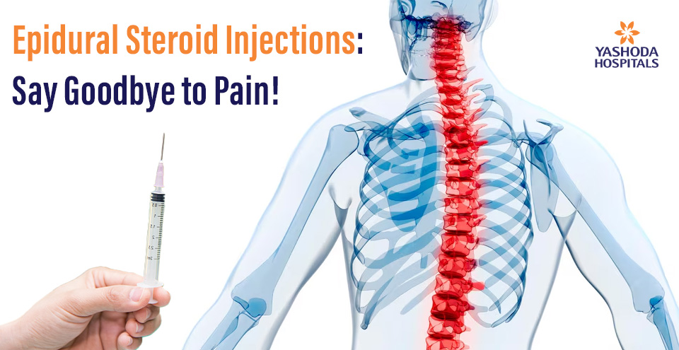 Epidural Steroid Injections: Say Goodbye to Pain!