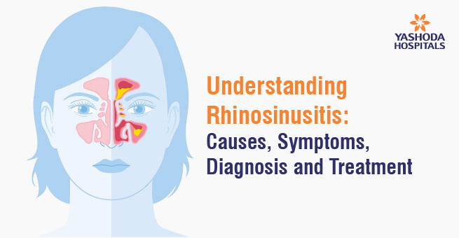 Understanding Rhinosinusitis: Causes, Symptoms, Diagnosis, and Treatment